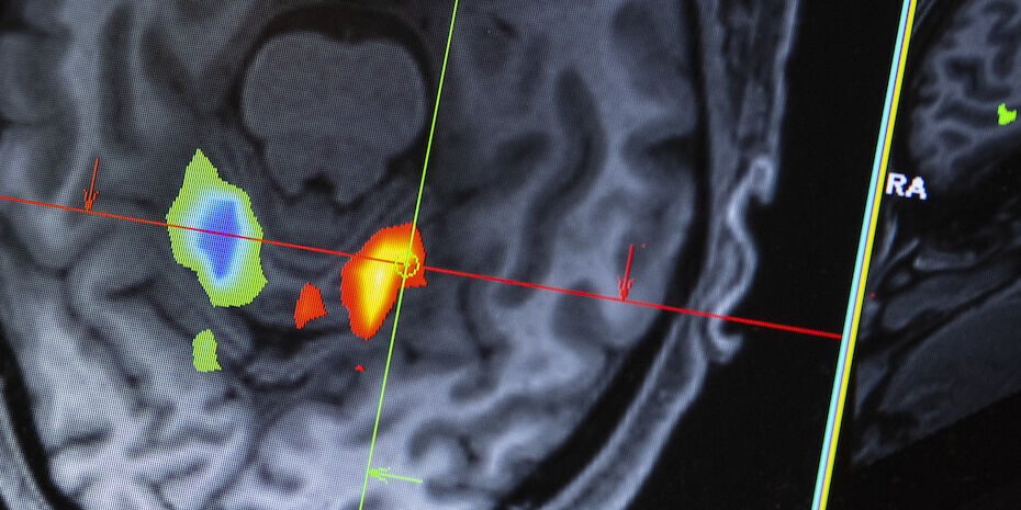 fMRI image of a brain scan