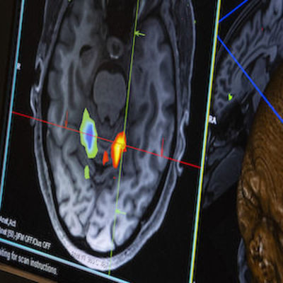 Petscan image of a brain 